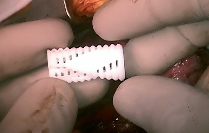 Illustration for article titled These 3D-Printed Devices Can Repair Damaged Airways in Kids' Lungs
